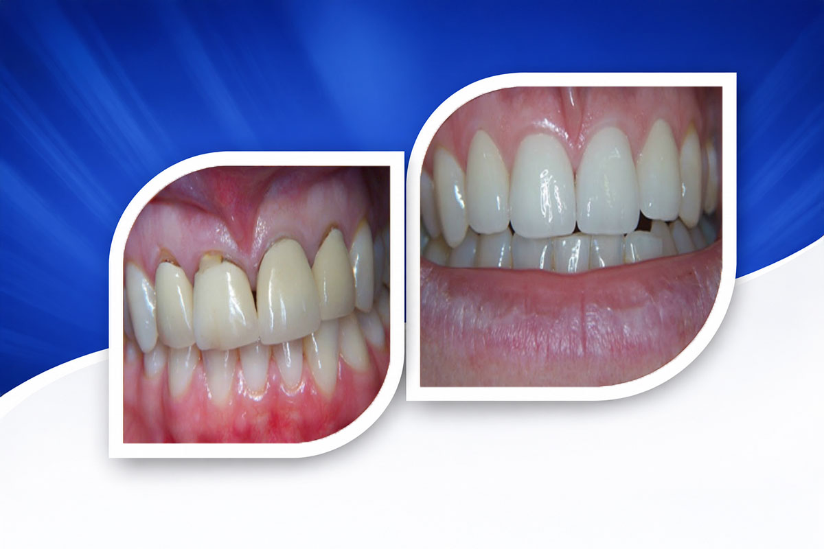 Root Canal Treatment in New Delhi